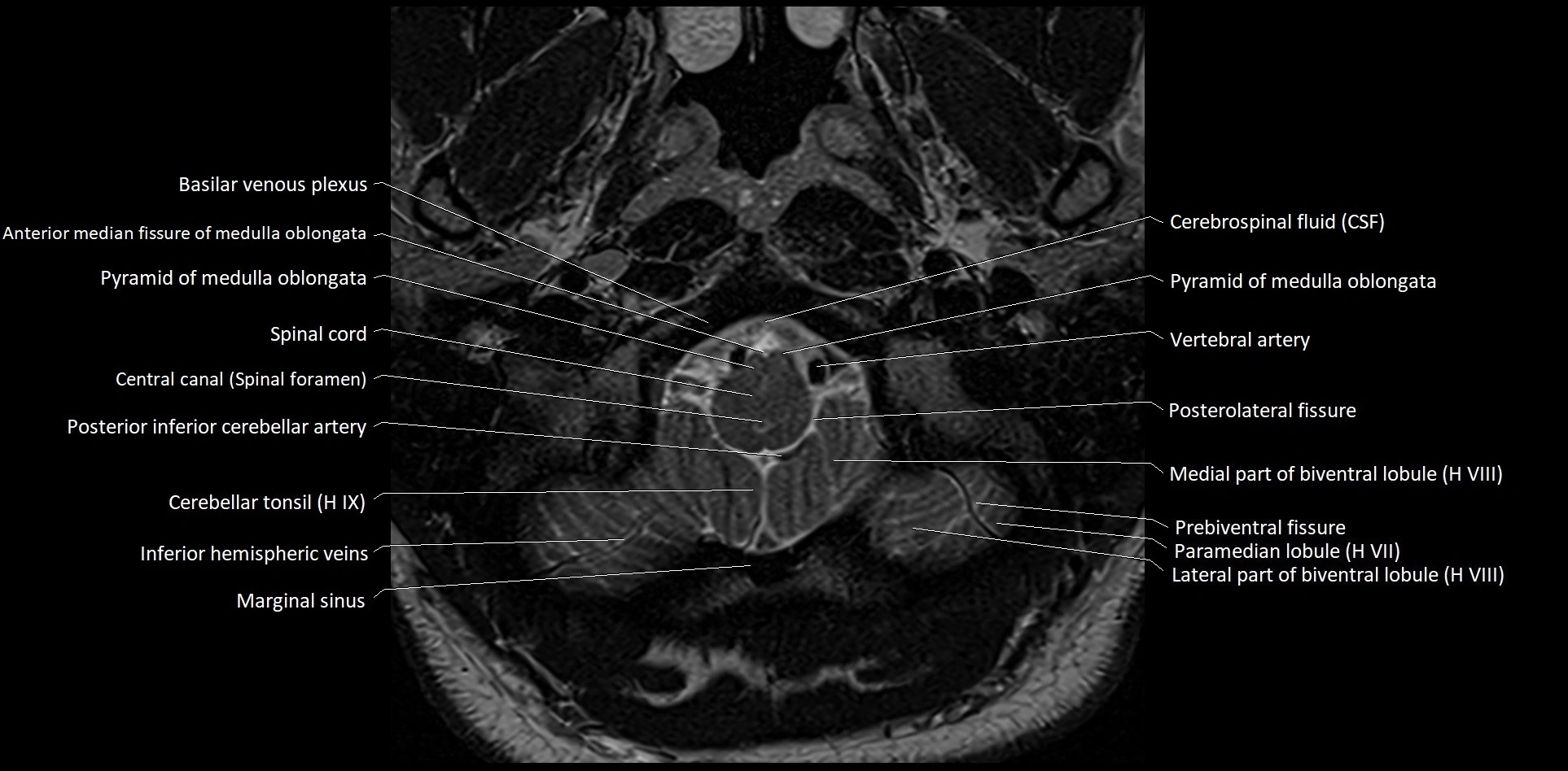 MRI Cerebellar anatomy High-resolution labelled 3T MRI image 2.webp